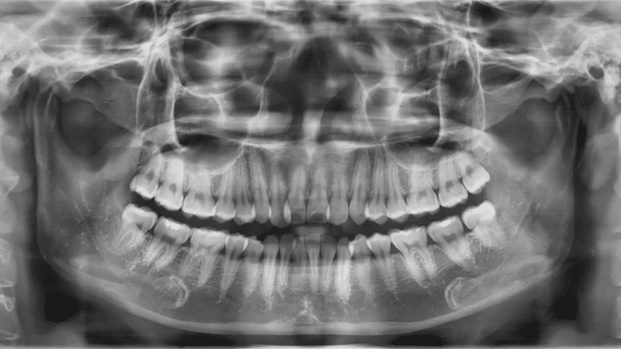 Chụp x-quang nha khoa có tác hại không