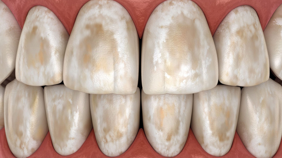 Cách khắc phục men răng yếu