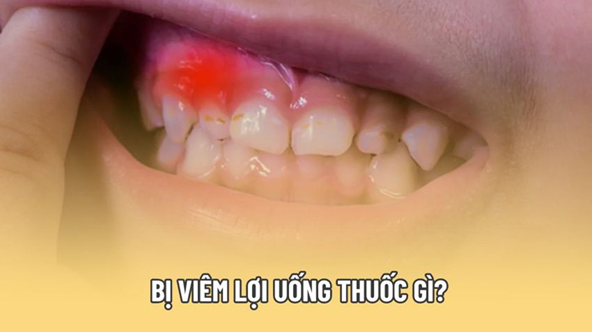 Bị viêm lợi uống thuốc gì nhanh hết bệnh?