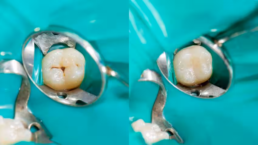 Quy trình trám răng