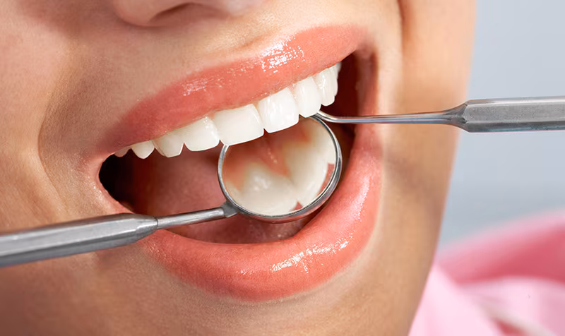 Trám răng là biện pháp phục hồi những chiếc răng bị tổn thương do sâu răng.