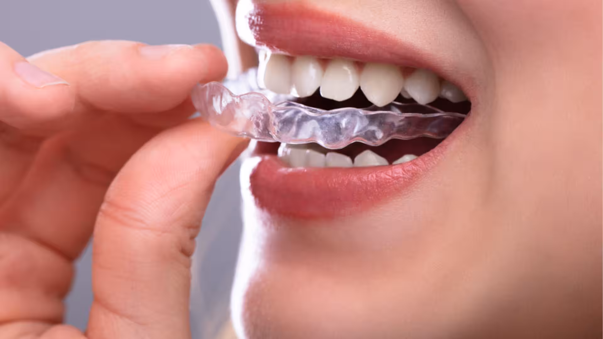 Vai trò và cách sử dụng máng chống nghiến răng khi ngủ