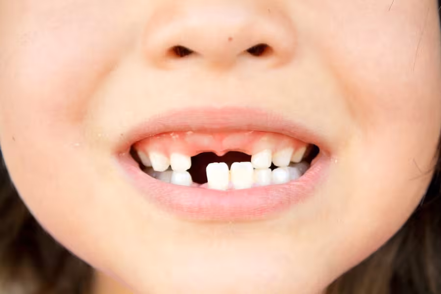 sâu răng ở trẻ em khiến gãy răng