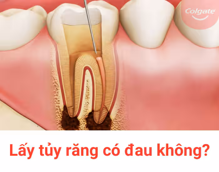 Lấy tủy răng có đau không?