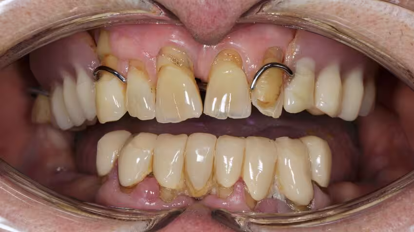 Tình trạng tụt lợi nặng