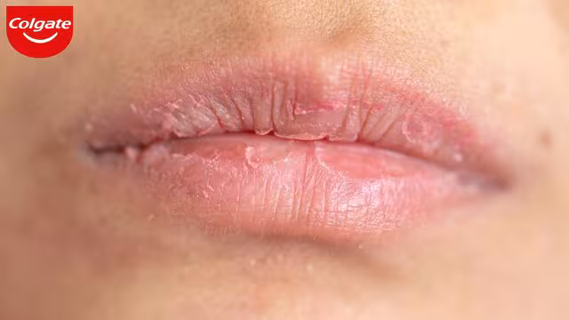 Bệnh khô miệng là gì