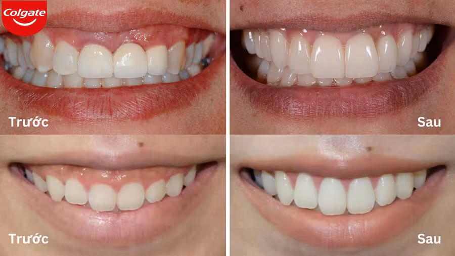 Phẫu thuật cắt lợi là gì?