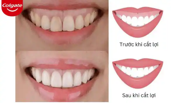 Phẫu thuật tạo hình nướu thẩm mỹ