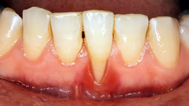 Biến chứng của tụt nướu ảnh hưởng đến sức khỏe