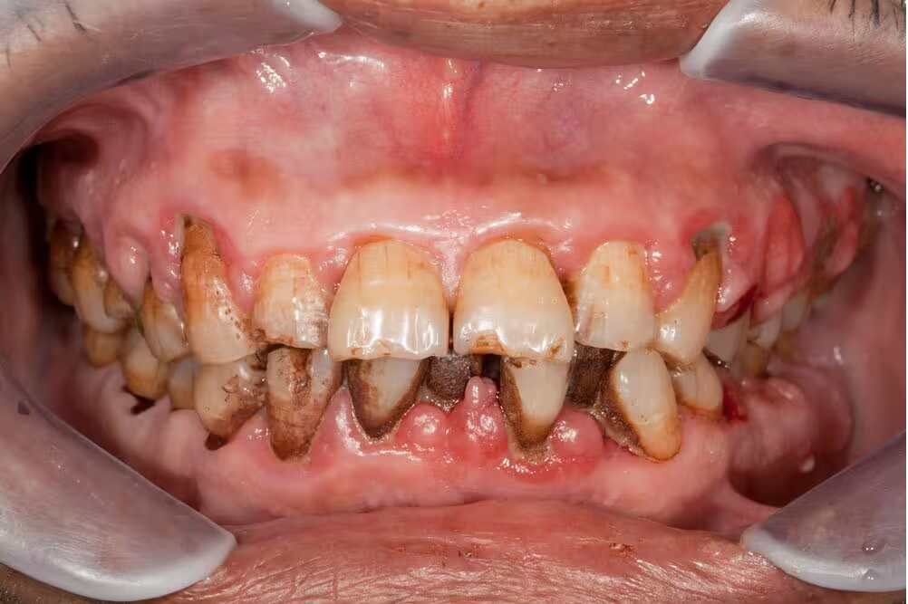black tartar on teeth