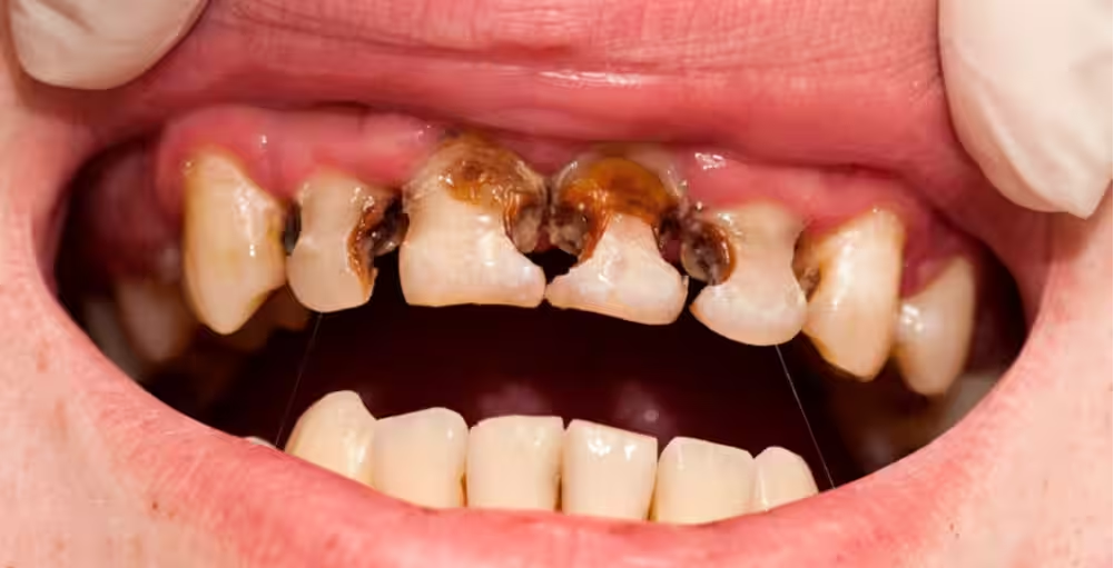 black tartar on teeth