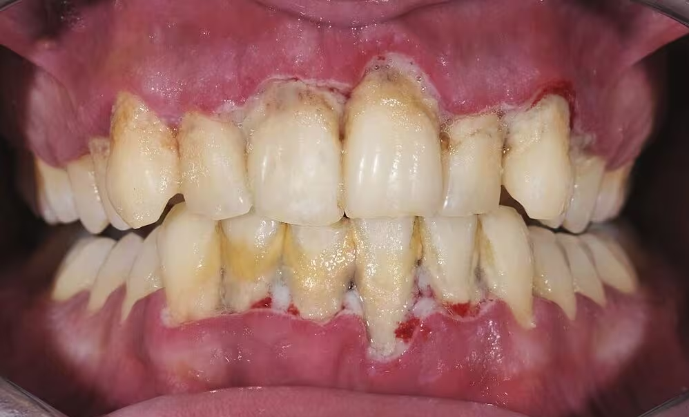 black tartar on teeth