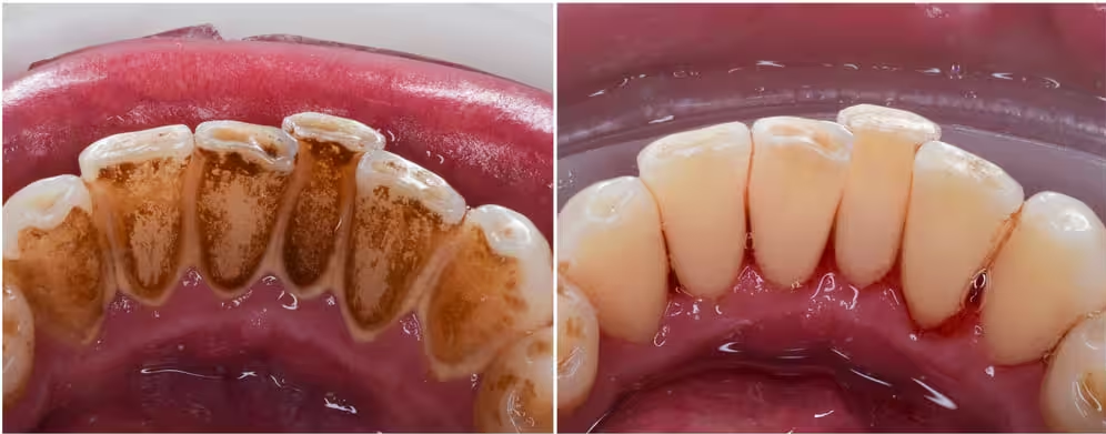 black tartar on teeth