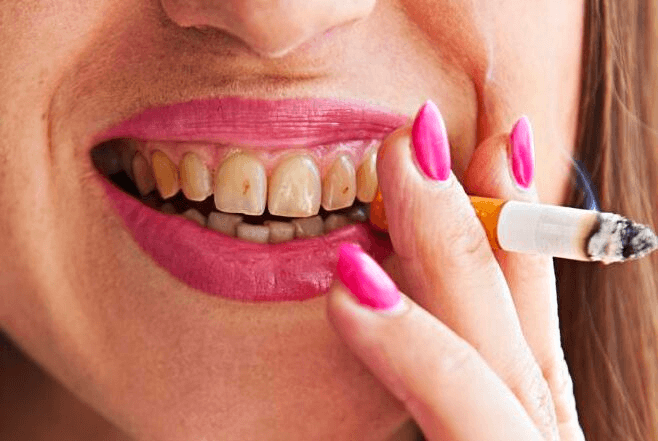Hút thuốc lá làm răng bị vàng, xỉn màu