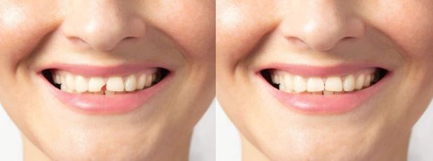 răng cửa bị mẻ do va đập mạnh