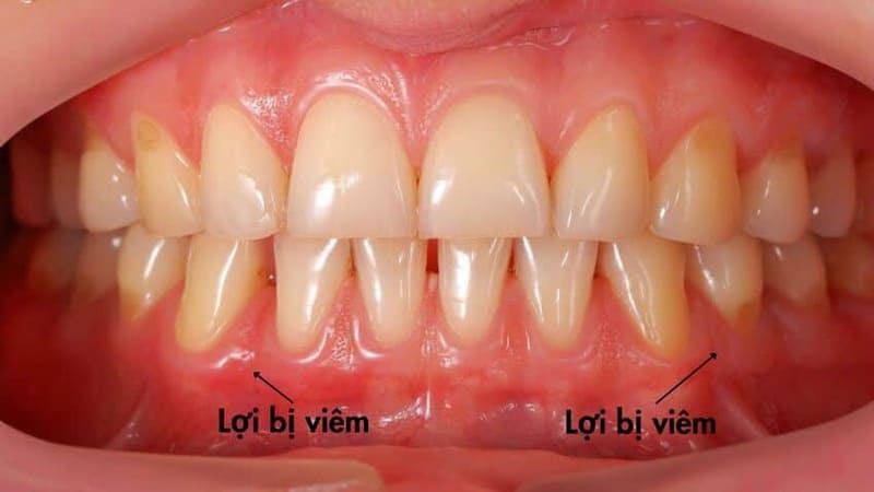 Viêm lợi không do mảng bám