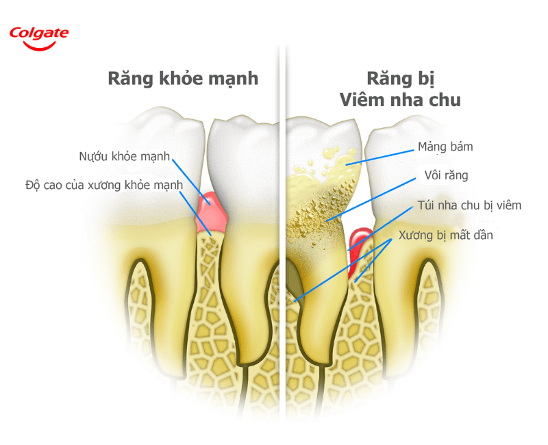 Viêm nha chu là tình trạng tổ chức quanh răng bị viêm nhiễm