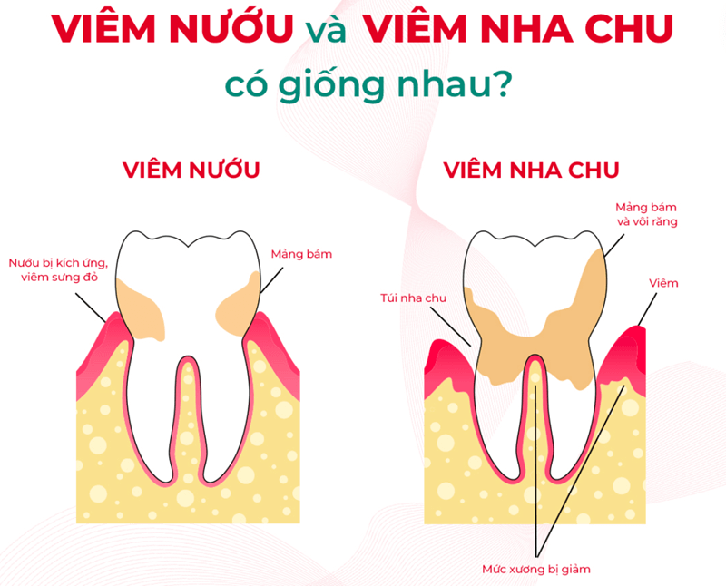 Phân biệt viêm nha chu và viêm nướu