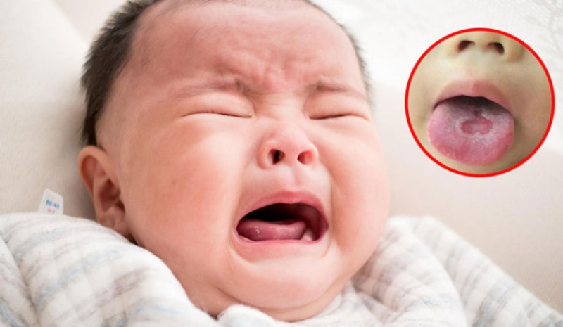 Chăm sóc bé khi bị nấm miệng