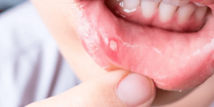 Dấu hiệu bị lở miệng, loét miệng