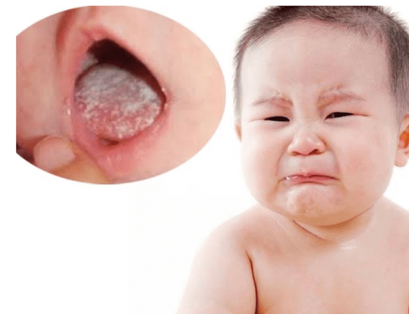 Cách điều trị bệnh tưa miệng do nấm Candida gây nên