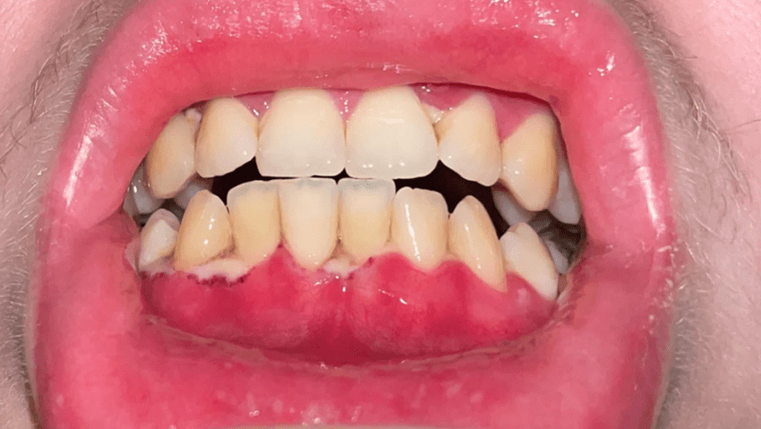 Xuất hiện mảng bám màu trắng trên nướu