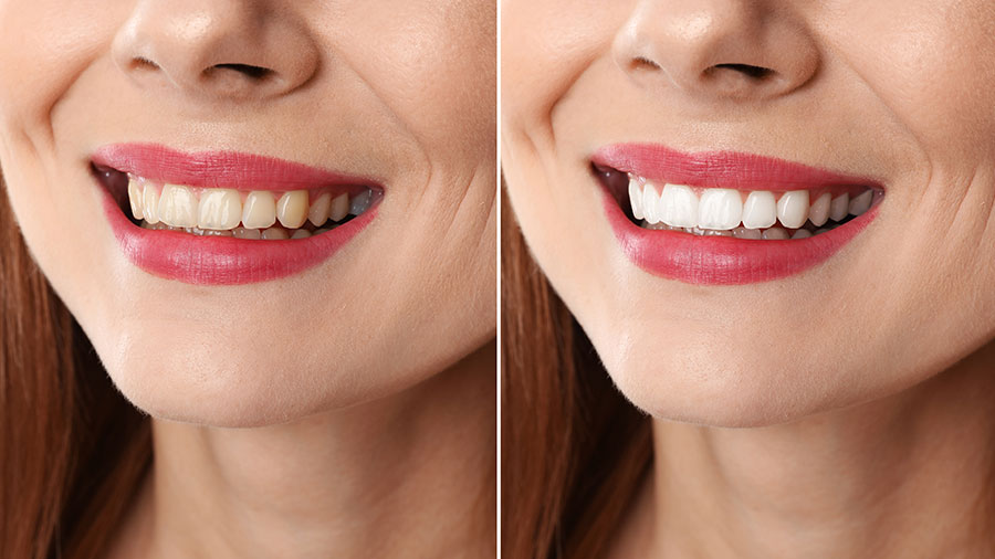 Chi phí làm trắng răng trước và sau khi thực hiện